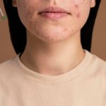Gyulladt pattanások az arcon: hatékony kezelési módszerek